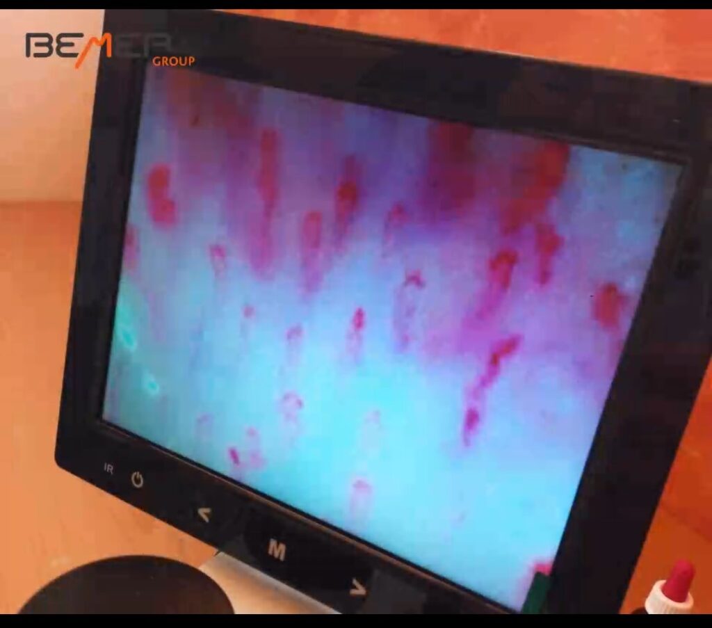 Kapillarmikroskop zeigt mikroskopische Aufnahme von Kapillaren.